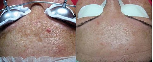 Melasma treatment before and after