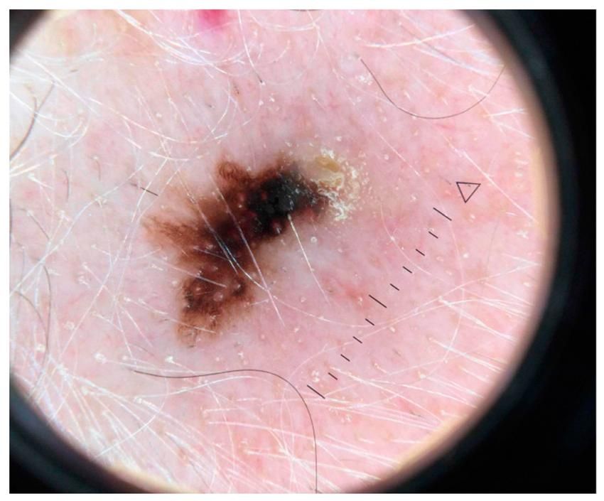 Melanoma — clinical example 3