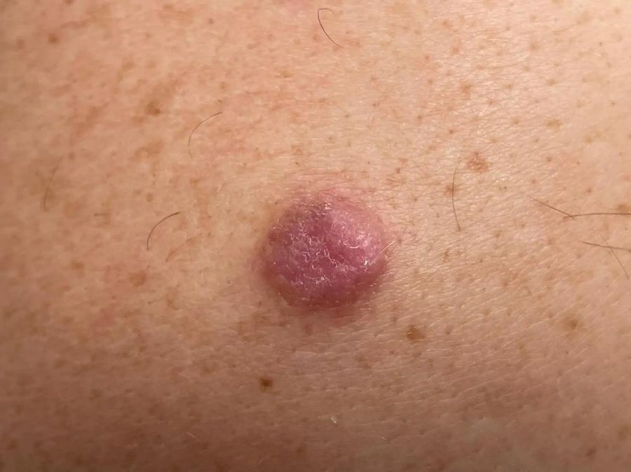 Nodular melanoma — example 3