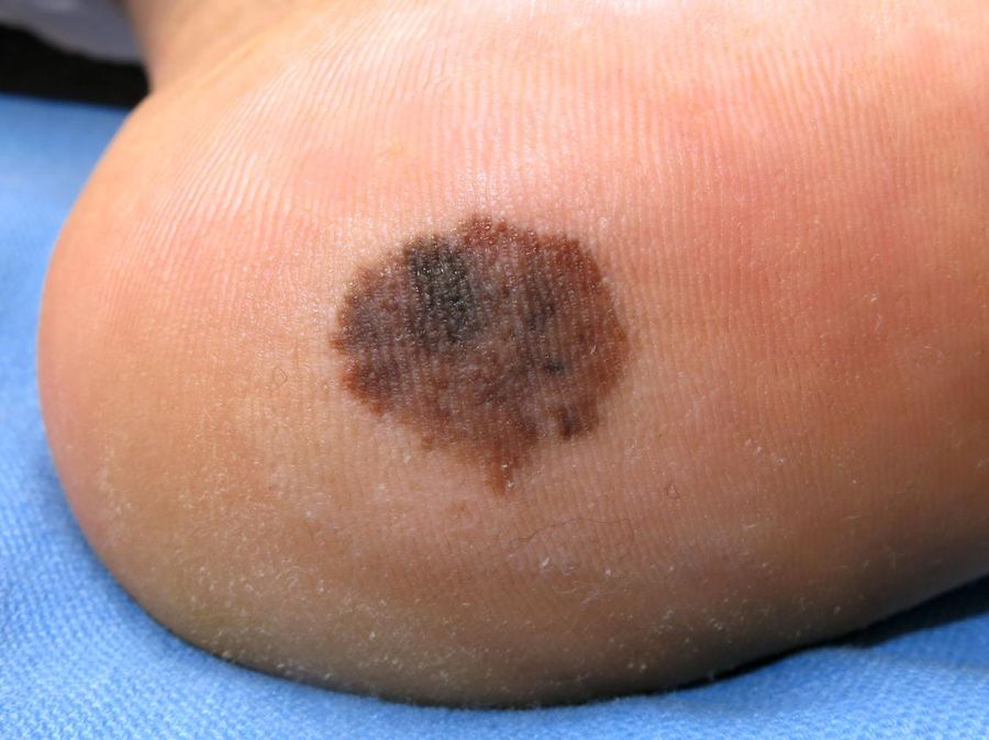 Acral lentiginous melanoma — example 1