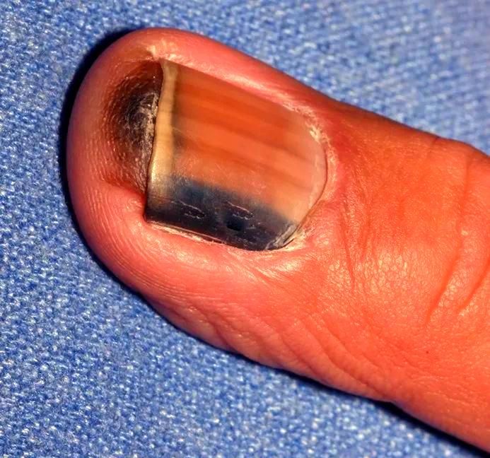 Acral lentiginous melanoma — example 2