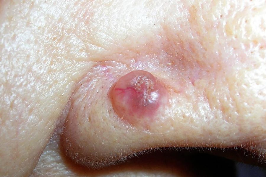 BCC — clinical example 1