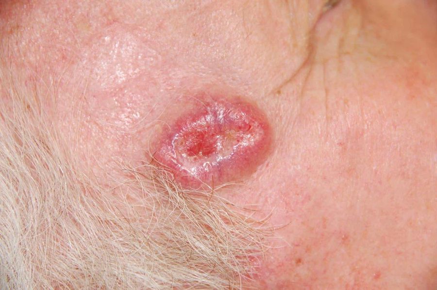 BCC — clinical example 3