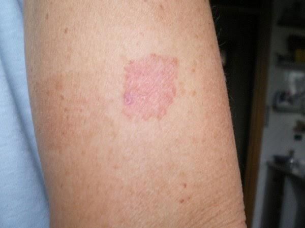 Superficial BCC — example 1