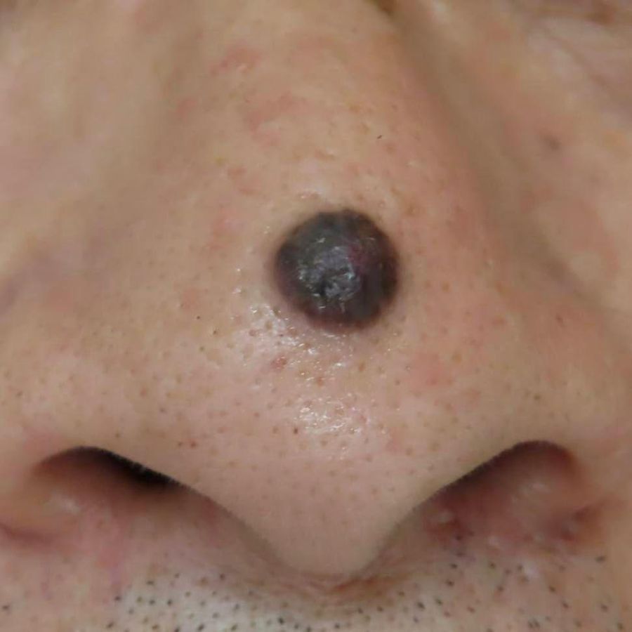 Pigmented BCC — example 2