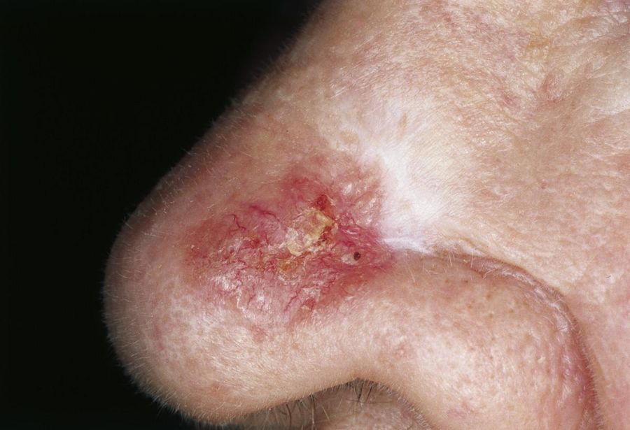 Infiltrative BCC — example 2