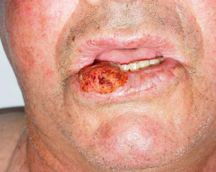SCC — clinical example 2