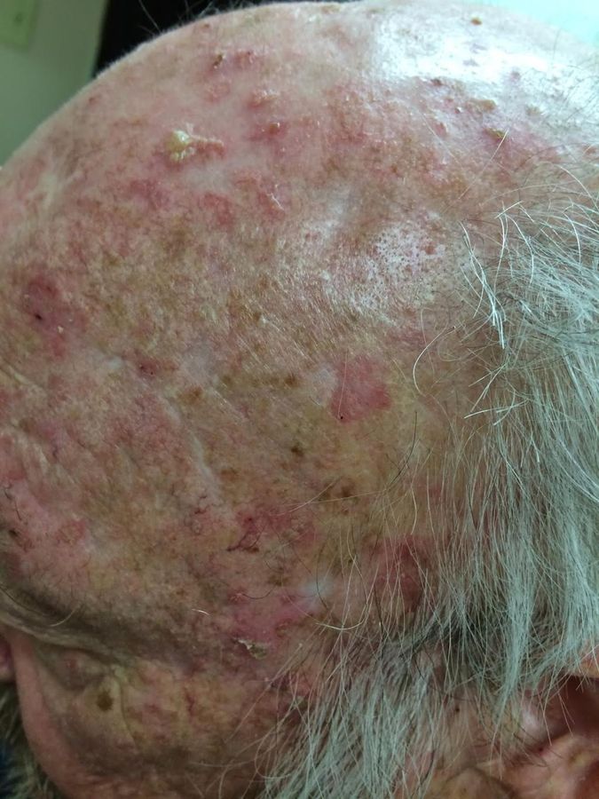 SCC risk factors — example 1