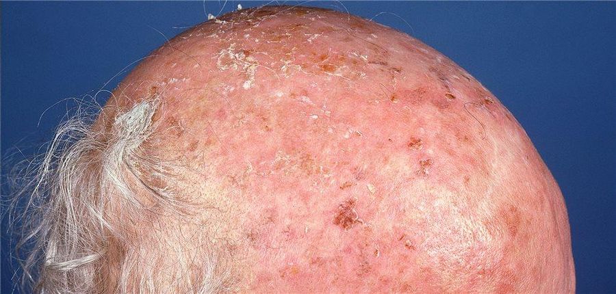SCC risk factors — example 3