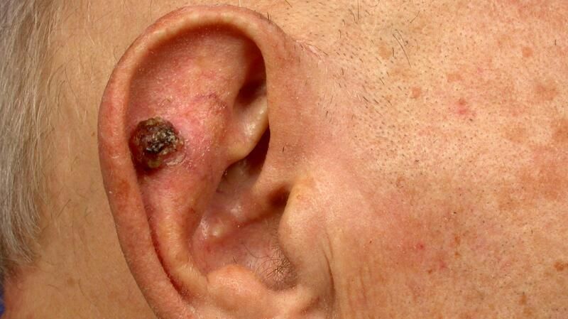 High-risk SCC — example 3