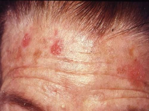 Actinic keratosis — example 3