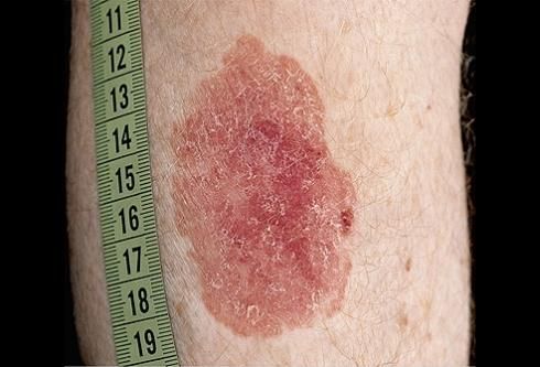 Bowen disease — example 2