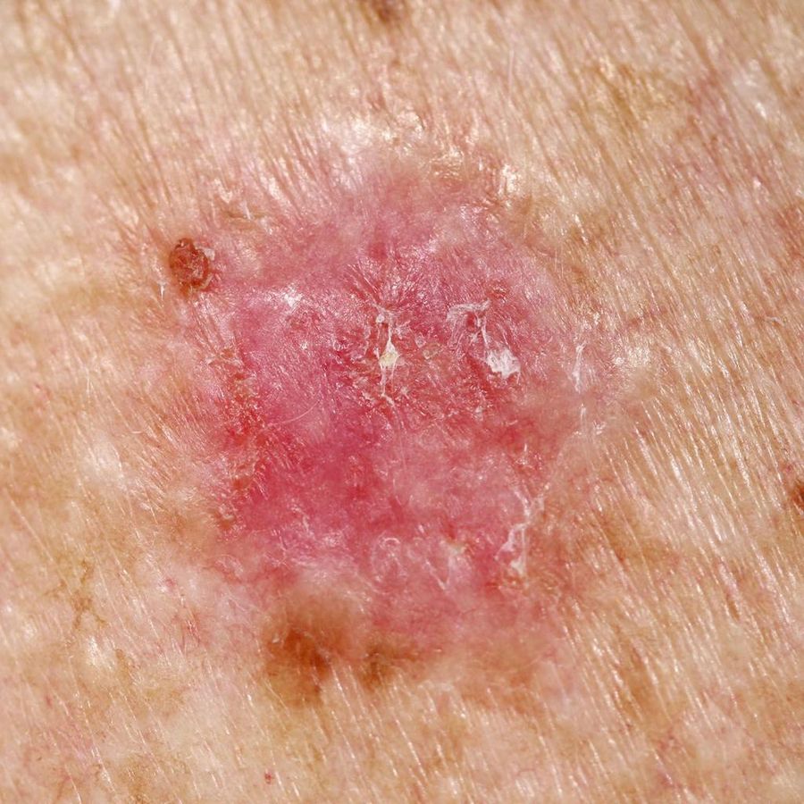 Bowen disease — example 3